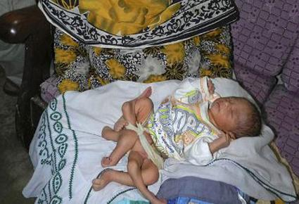 ولادة طفل بـ 6 أرجل في باكستان